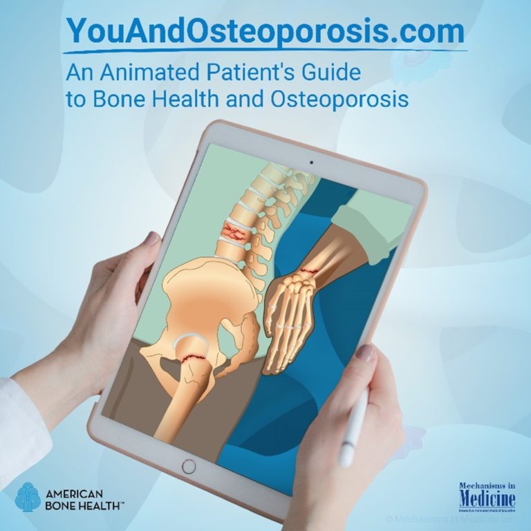 You and Osteoporosis: An Animated Patient’s Guide to Bone Health and ...